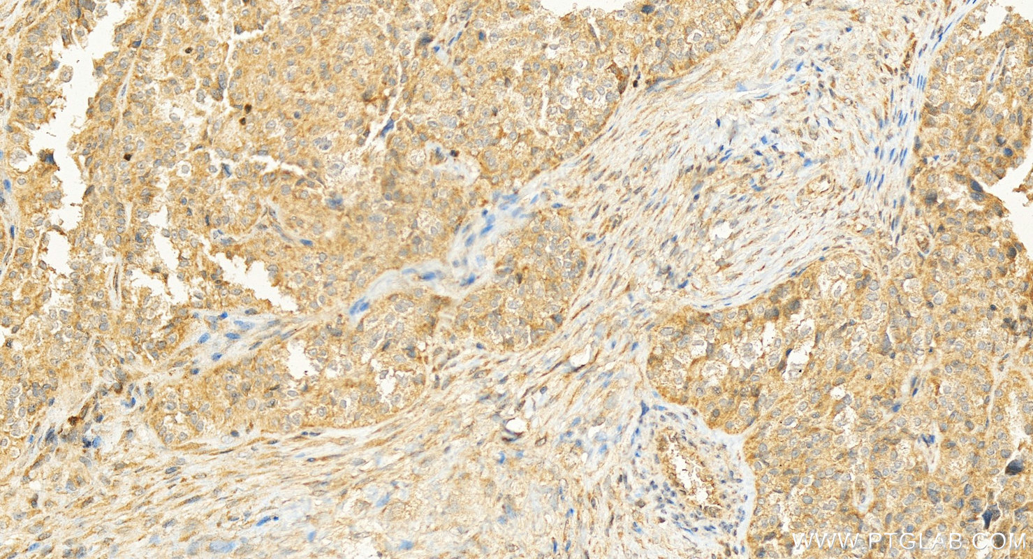 IHC staining of human ovary cancer using 19713-1-AP