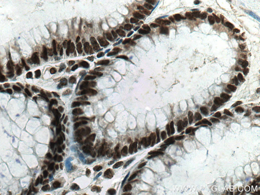 IHC staining of human colon cancer using 67462-1-Ig (same clone as 67462-1-PBS)