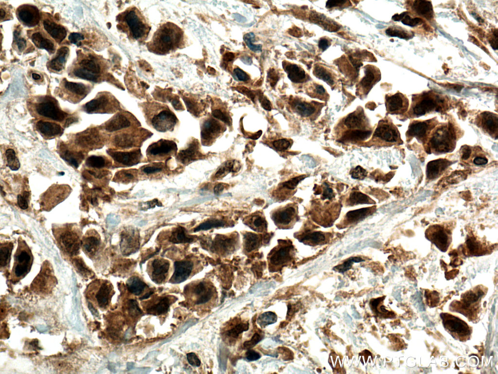 IHC staining of human breast cancer using 10047-1-AP