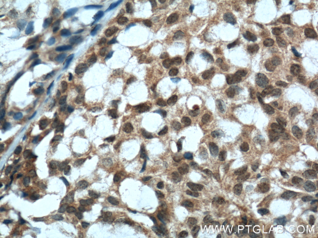 IHC staining of human breast hyperplasia using 60300-1-Ig