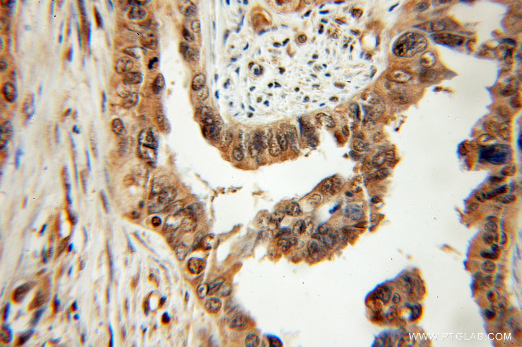 IHC staining of human ovary tumor using 11191-1-AP
