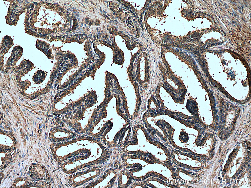 IHC staining of human prostate hyperplasia using 66921-1-Ig (same clone as 66921-1-PBS)