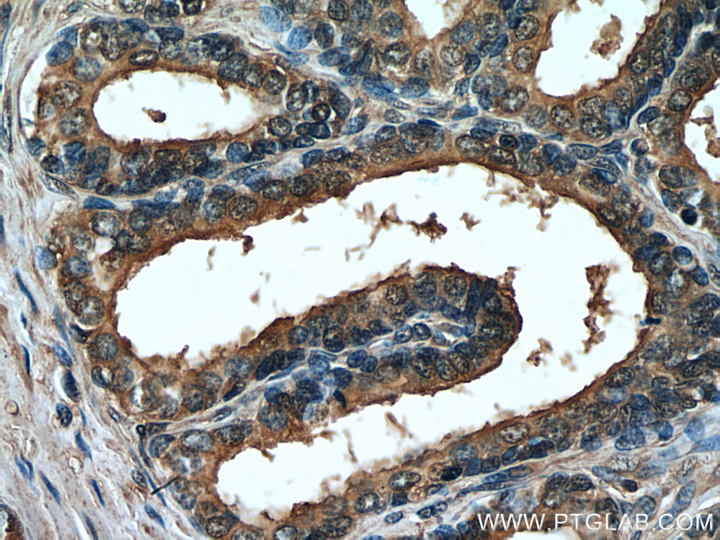 IHC staining of human prostate hyperplasia using 66921-1-Ig (same clone as 66921-1-PBS)