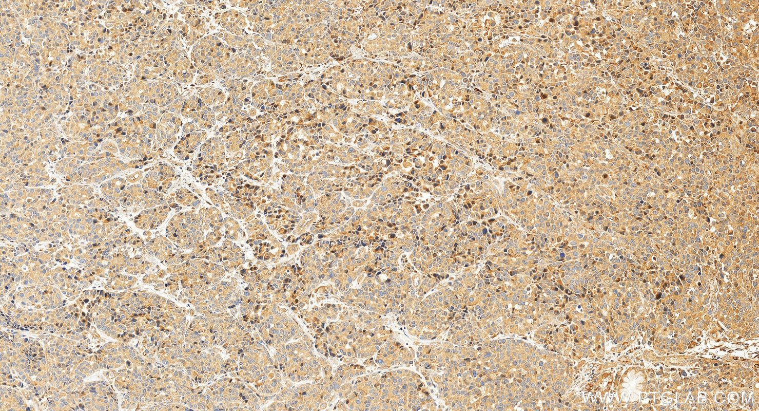 IHC staining of human stomach cancer using 10596-1-AP IHC staining of human stomach cancer using 10596-1-AP
