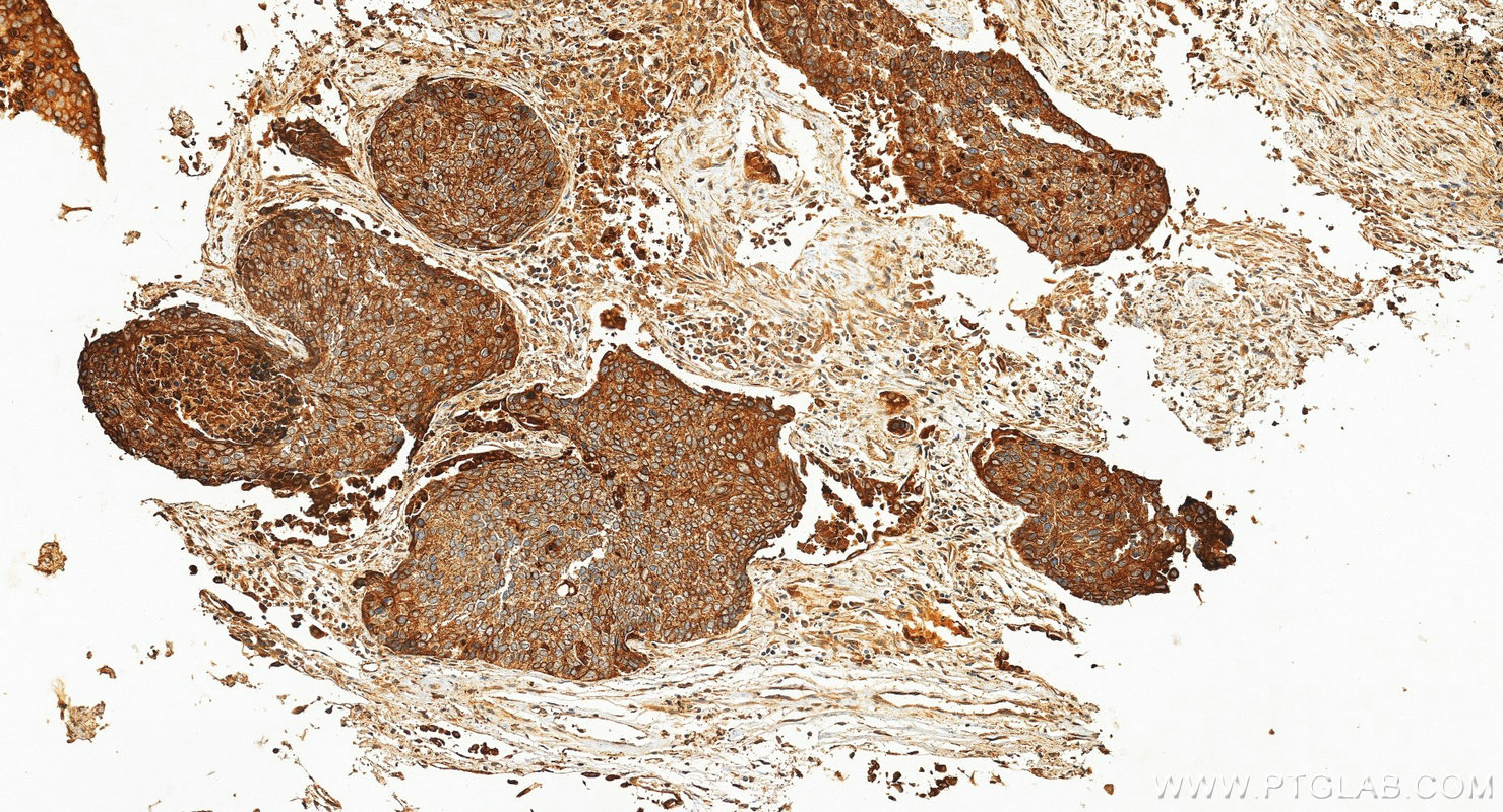 IHC staining of human lung cancer using 10596-1-AP IHC staining of human lung cancer using 10596-1-AP