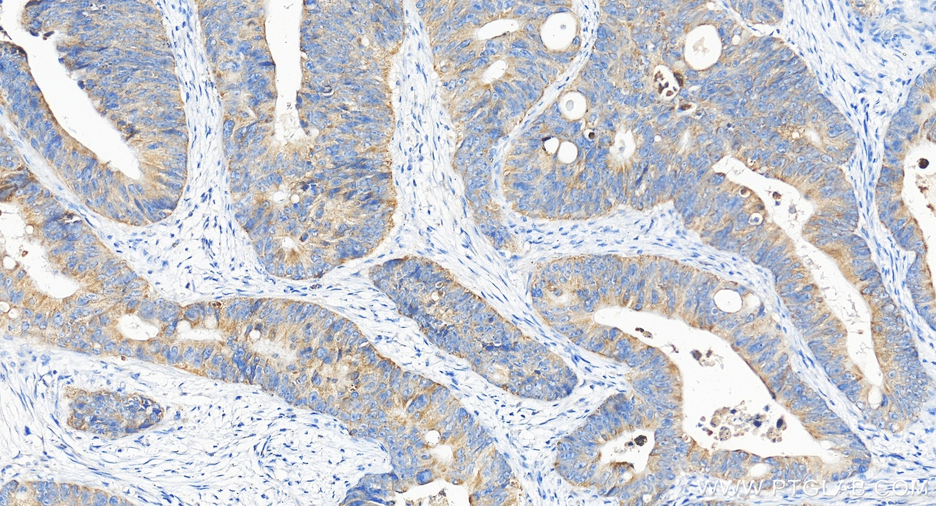 Immunohistochemical analysis of paraffin-embedded human colon cancer tissue slide using 85419-4-RR (PTGES2 antibody) at dilution of 1:200 (under 20x lens). Heat mediated antigen retrieval with Tris-EDTA buffer (pH 9.0). IHC staining of human colon cancer using 85419-4-RR