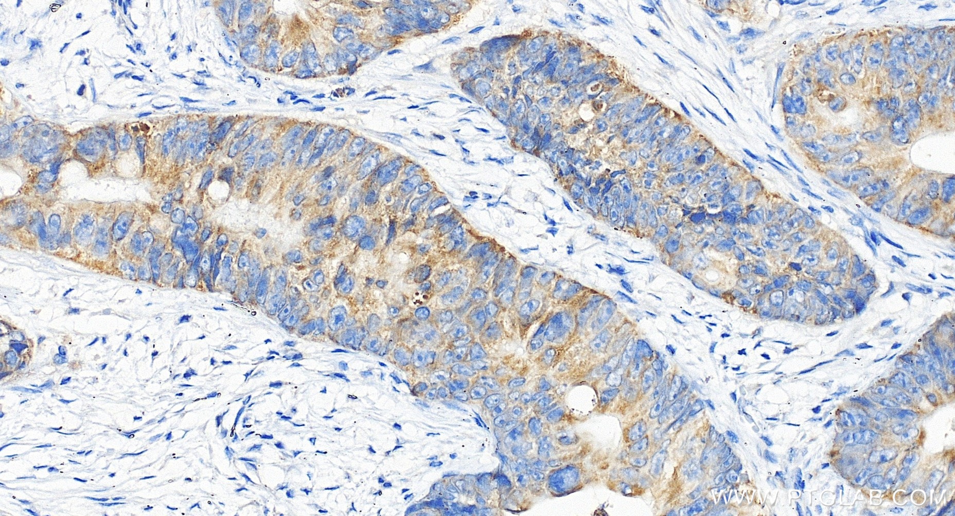 Immunohistochemical analysis of paraffin-embedded human colon cancer tissue slide using 85419-4-RR (PTGES2 antibody) at dilution of 1:200 (under 20x lens). Heat mediated antigen retrieval with Tris-EDTA buffer (pH 9.0). IHC staining of human colon cancer using 85419-4-RR