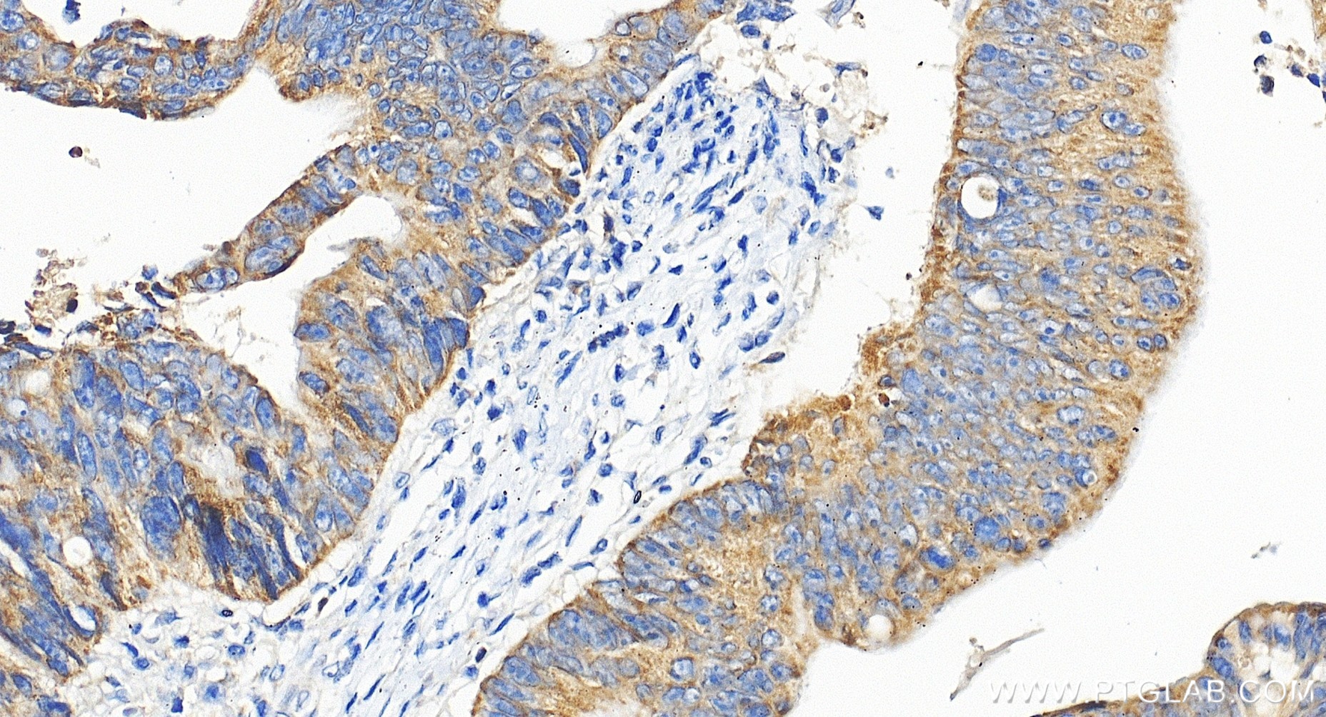Immunohistochemical analysis of paraffin-embedded human colon cancer tissue slide using 85419-4-RR (PTGES2 antibody) at dilution of 1:200 (under 40x lens). Heat mediated antigen retrieval with Tris-EDTA buffer (pH 9.0). IHC staining of human colon cancer using 85419-4-RR