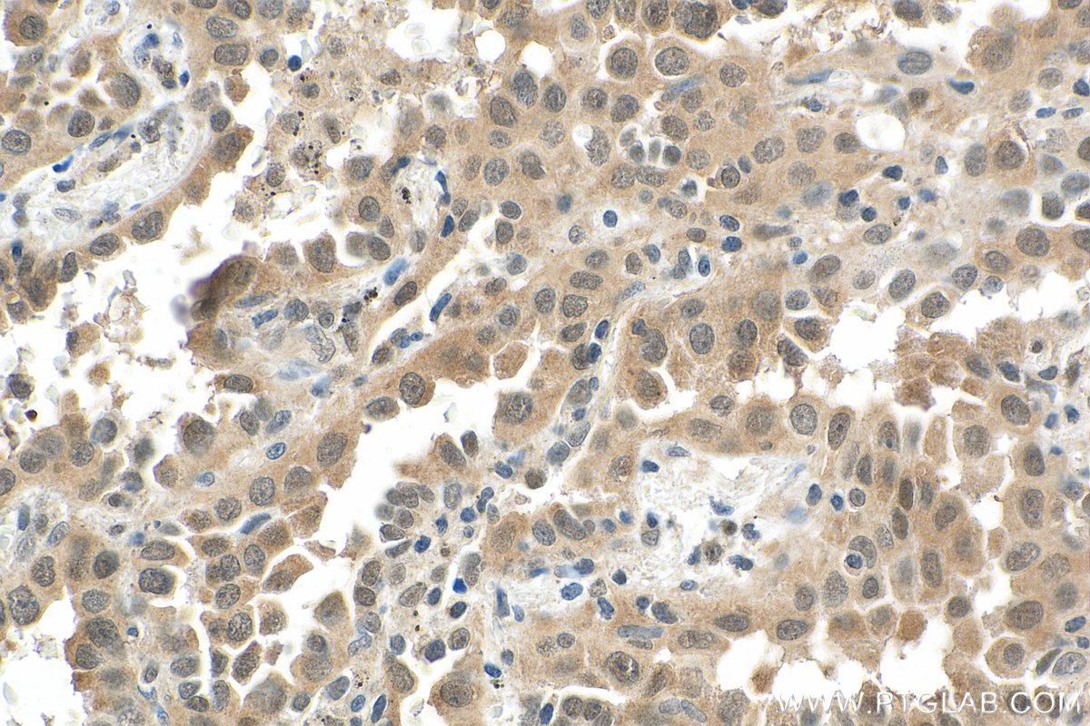 IHC staining of human lung cancer using 67736-1-Ig