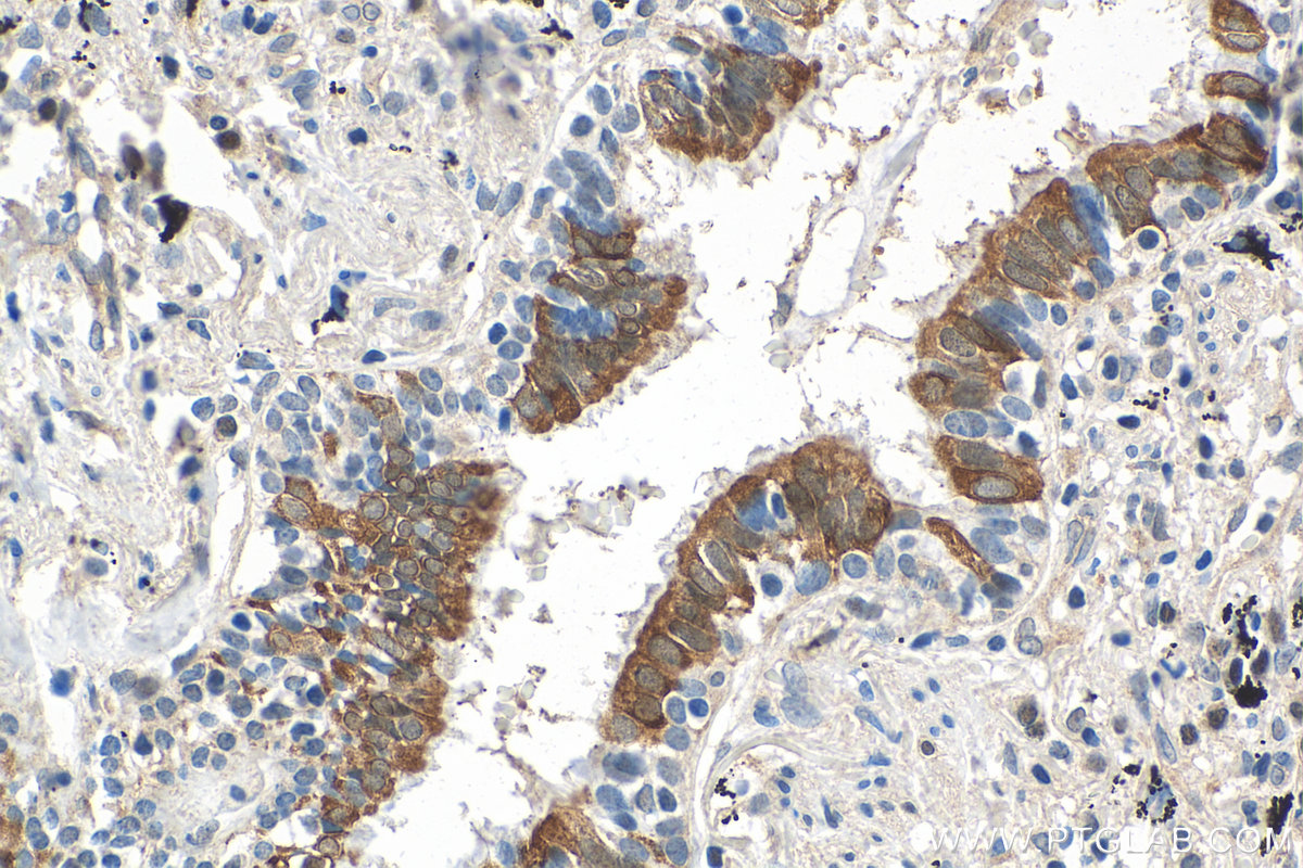 IHC staining of human lung cancer using 67736-1-Ig (same clone as 67736-1-PBS)