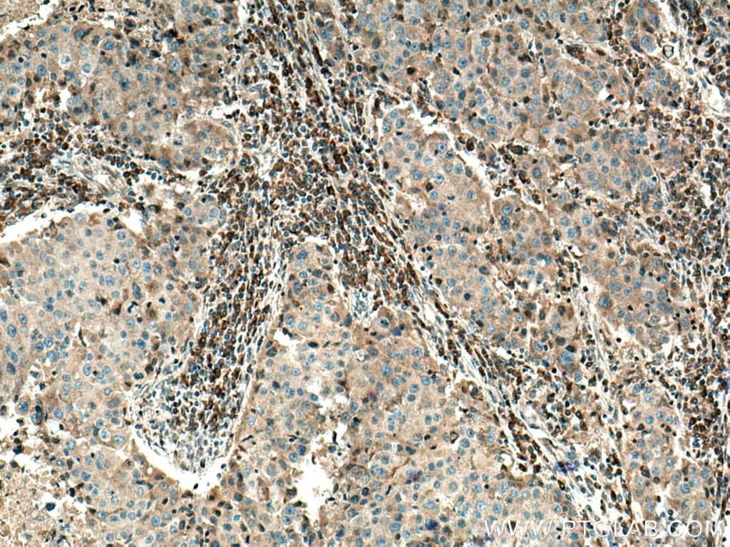 IHC staining of human breast cancer using 12375-1-AP