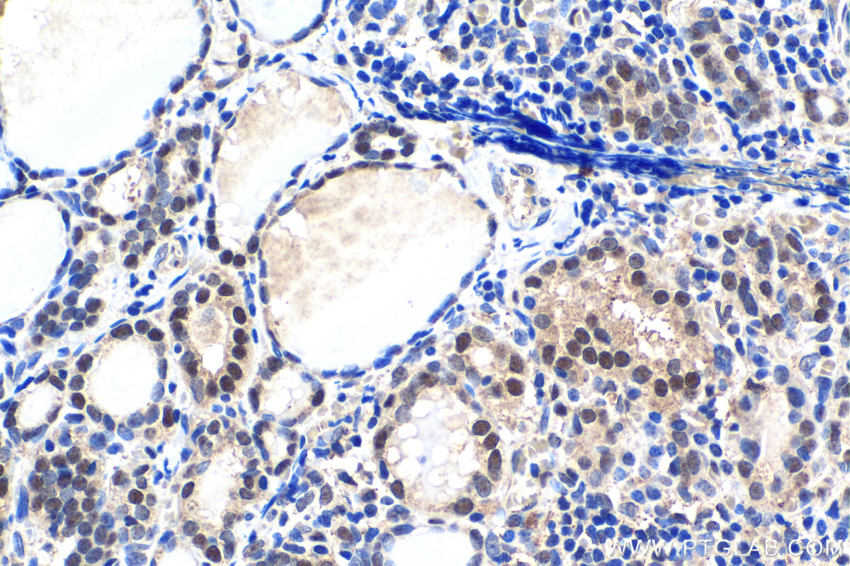 IHC staining of human thyroid cancer using 10480-1-AP