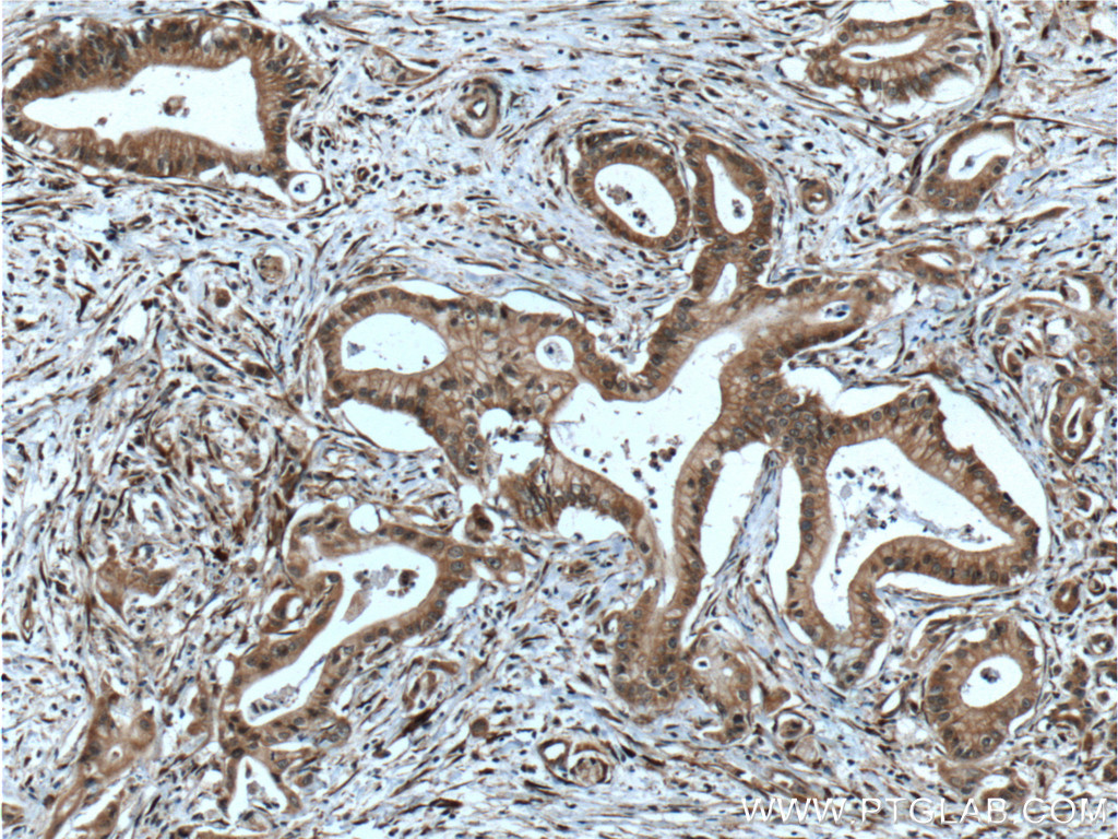 IHC staining of human pancreas cancer using 11508-1-AP