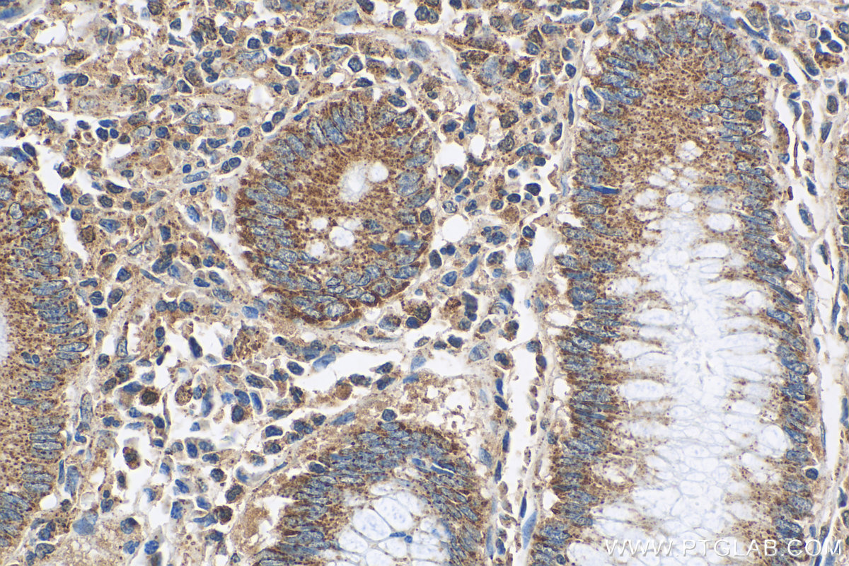 IHC staining of human colon cancer using 15186-1-AP