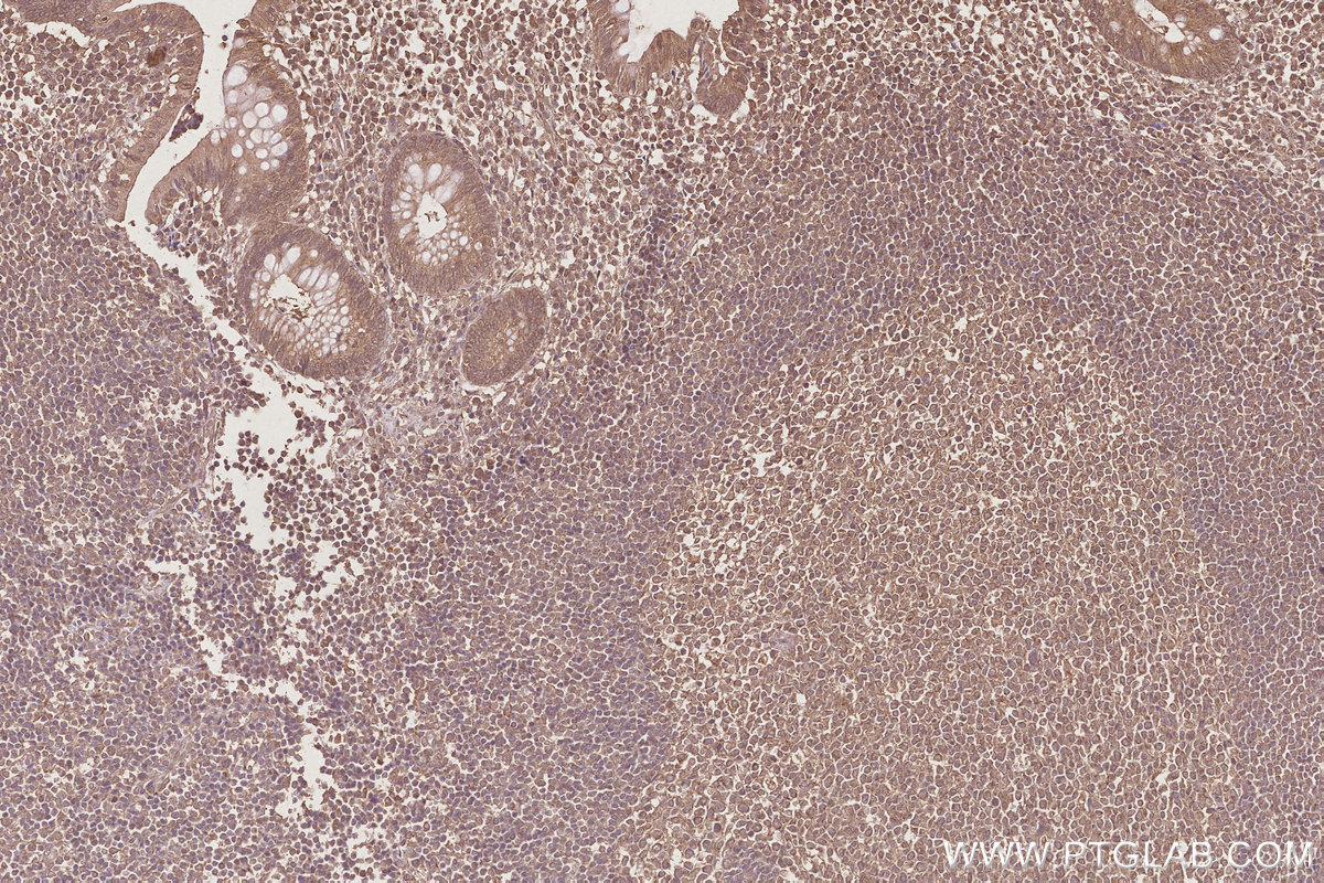 IHC staining of human appendicitis using 68582-1-Ig