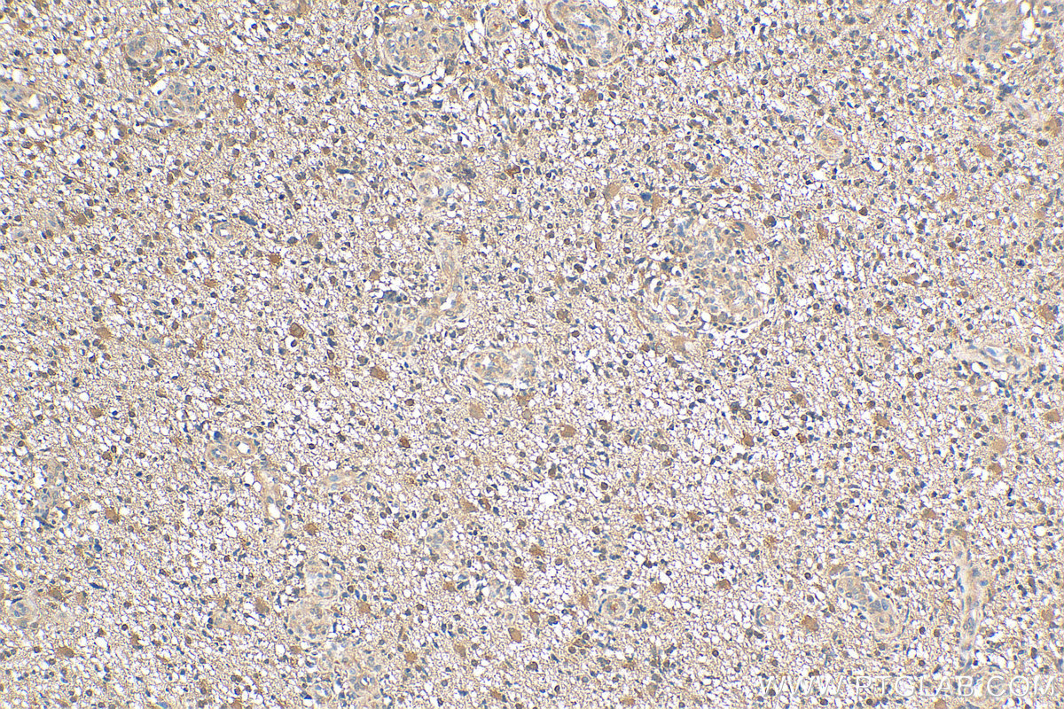 IHC staining of human gliomas using 20145-1-AP