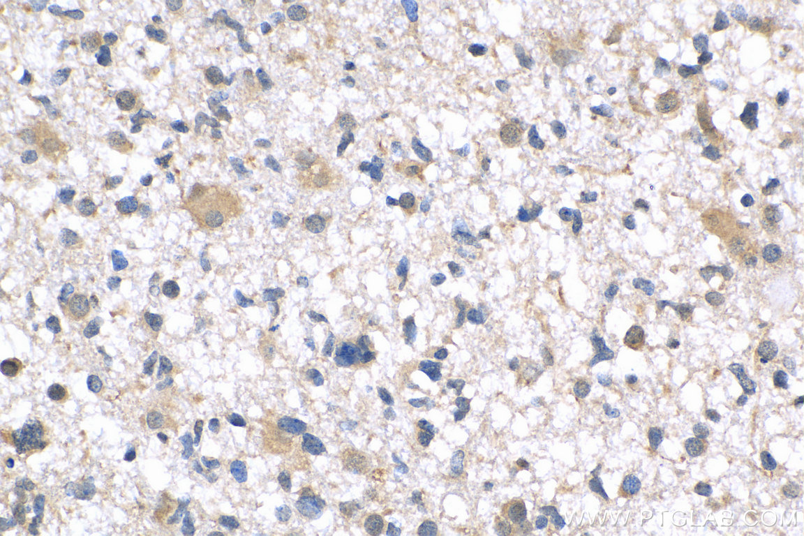 IHC staining of human gliomas using 24570-1-AP