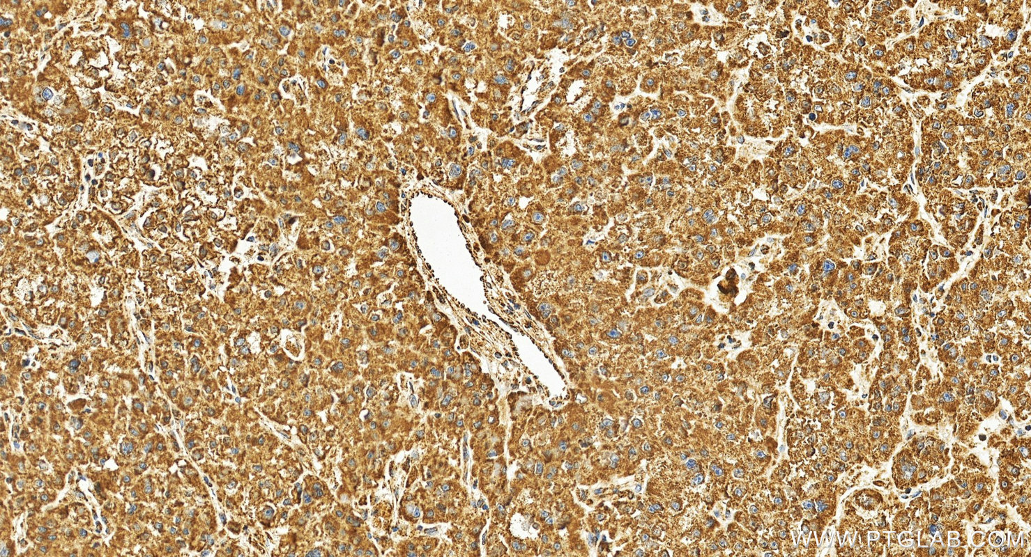 IHC staining of human Hepatocellular carcinoma using 82503-1-RR (same clone as 82503-1-PBS)