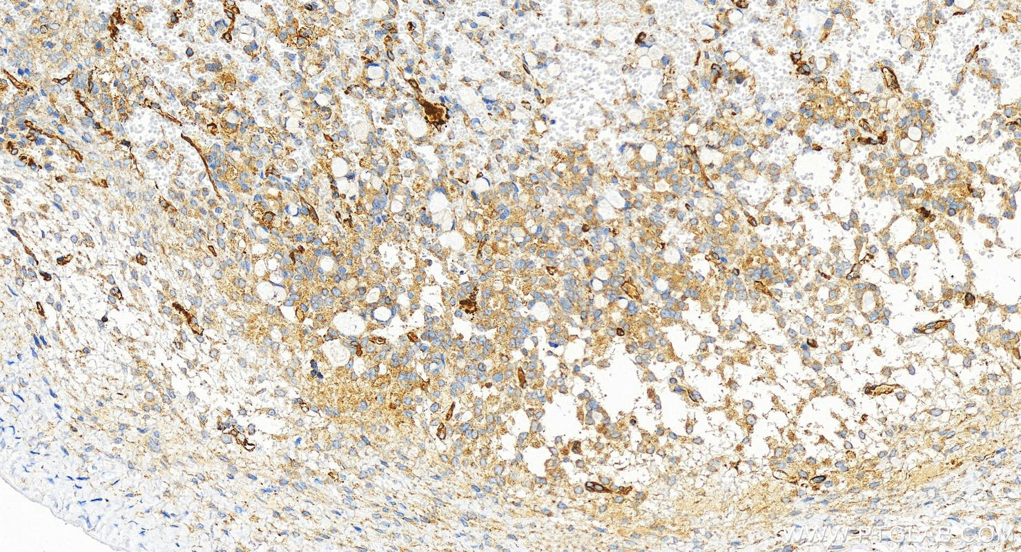 IHC staining of human ovary cancer using 83851-6-RR (same clone as 83851-6-PBS)