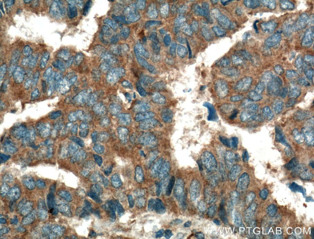 IHC staining of human colon cancer using 10472-1-AP