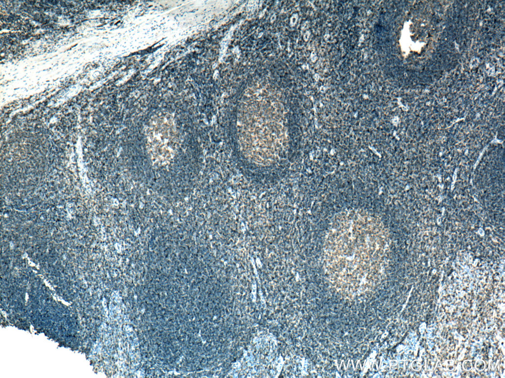 IHC staining of human tonsillitis using 19715-1-AP