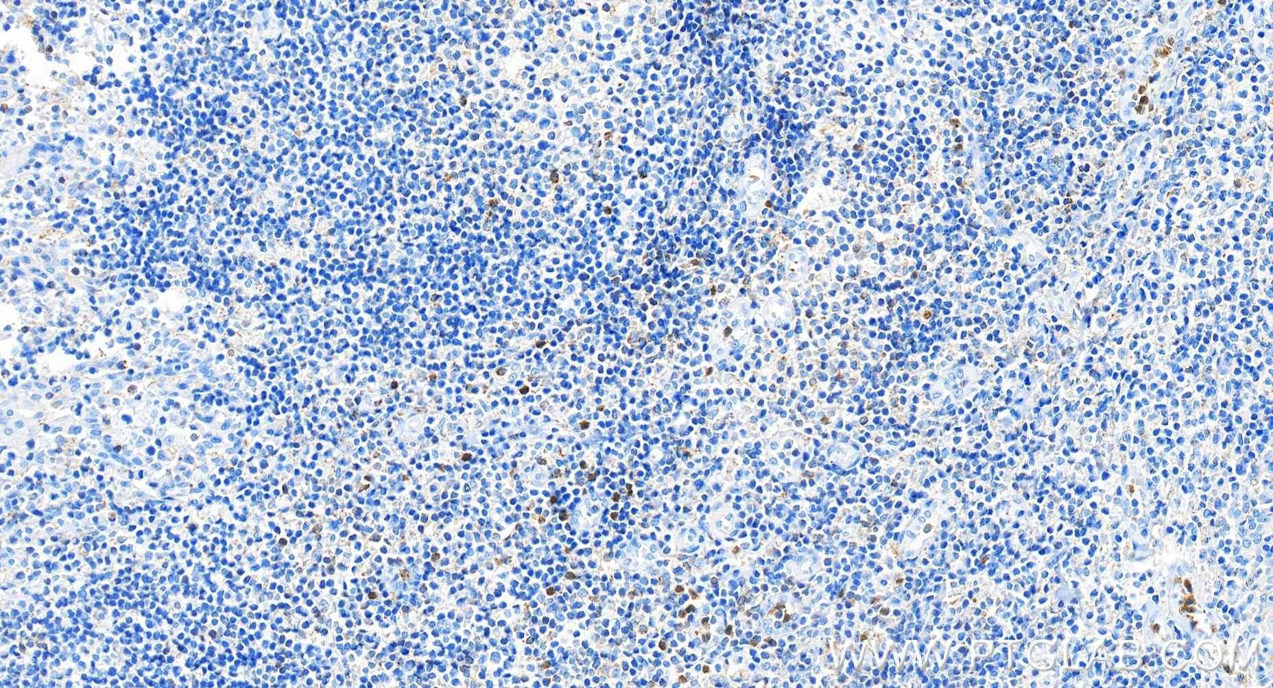 IHC staining of human tonsillitis using 98715-1-RR IHC staining of human tonsillitis using 98715-1-RR
