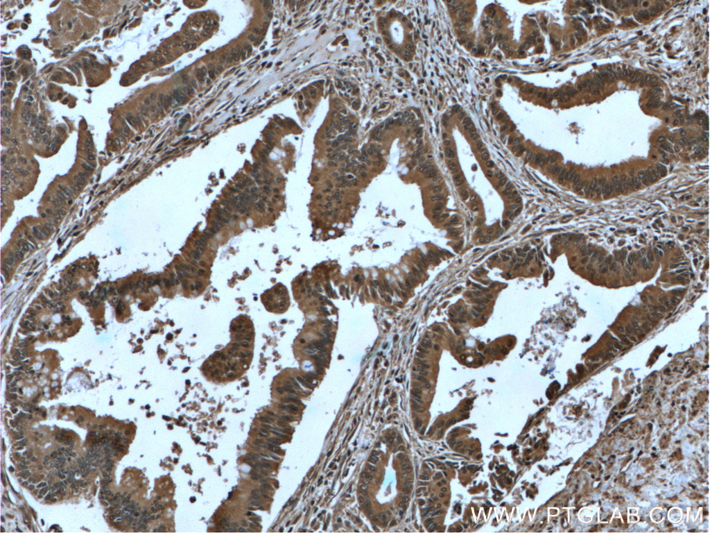 IHC staining of human pancreas cancer using 66045-1-Ig