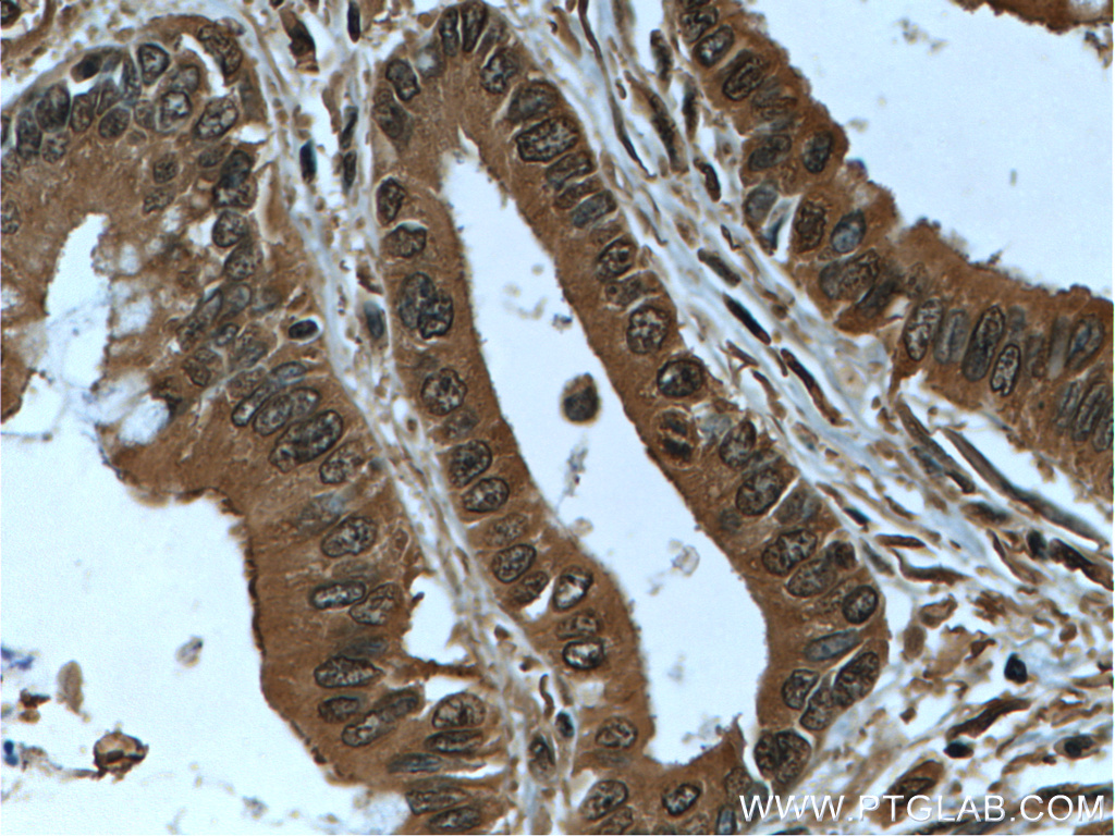 IHC staining of human pancreas cancer using 66045-1-Ig