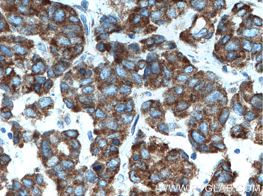 IHC staining of human prostate cancer using 51006-2-AP