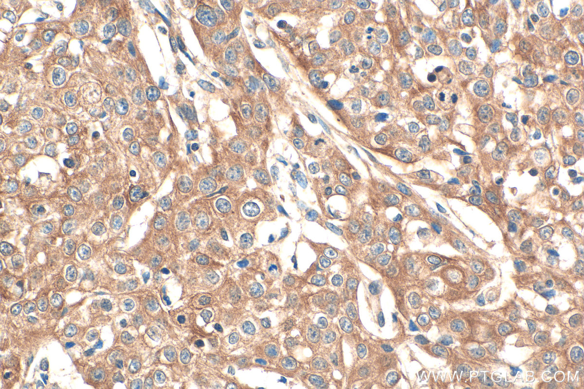 IHC staining of human cervical cancer using 13797-1-AP