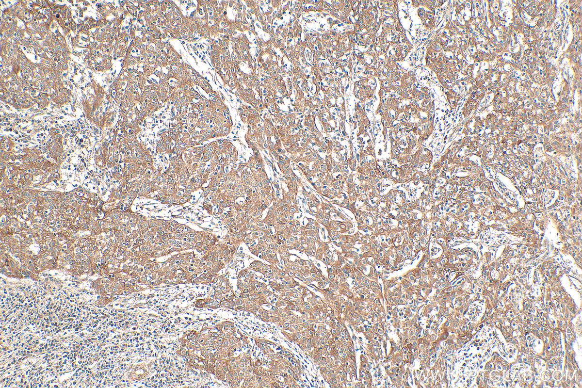 IHC staining of human cervical cancer using 13797-1-AP