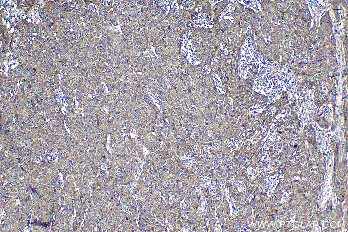 IHC staining of human cervical cancer using 27486-1-AP