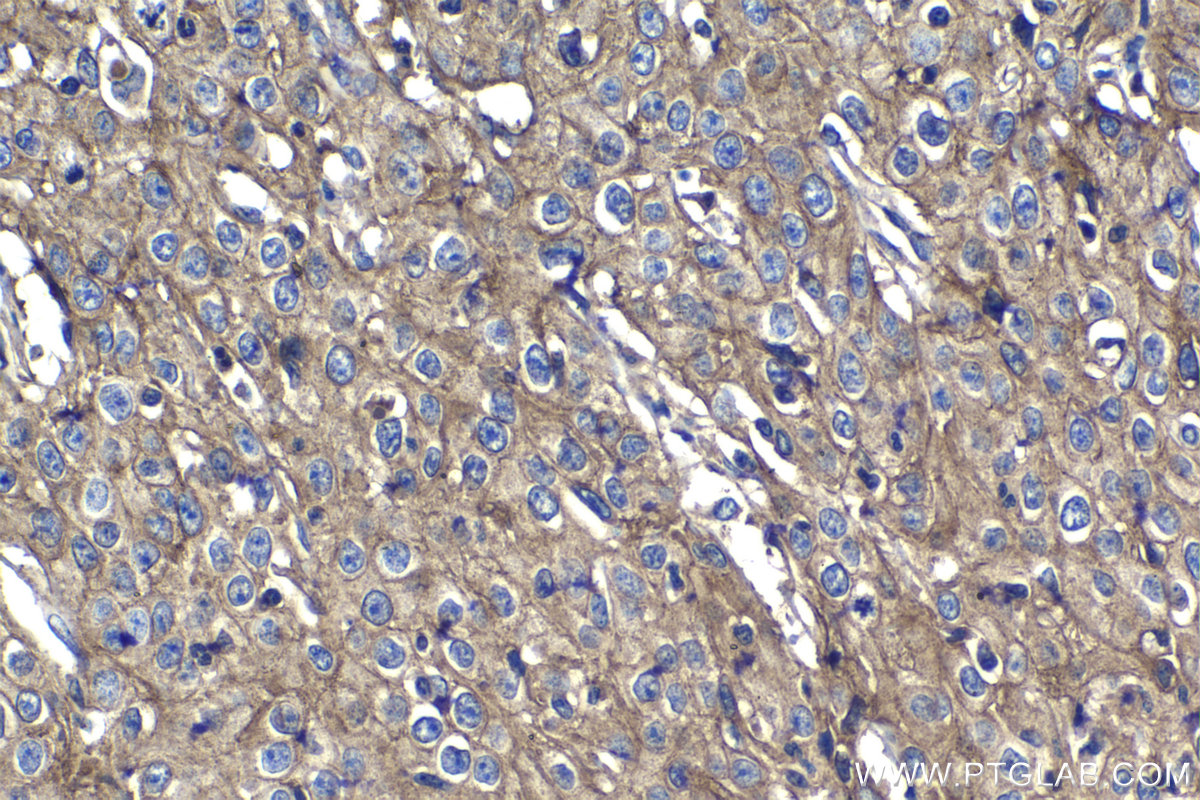 IHC staining of human cervical cancer using 27486-1-AP