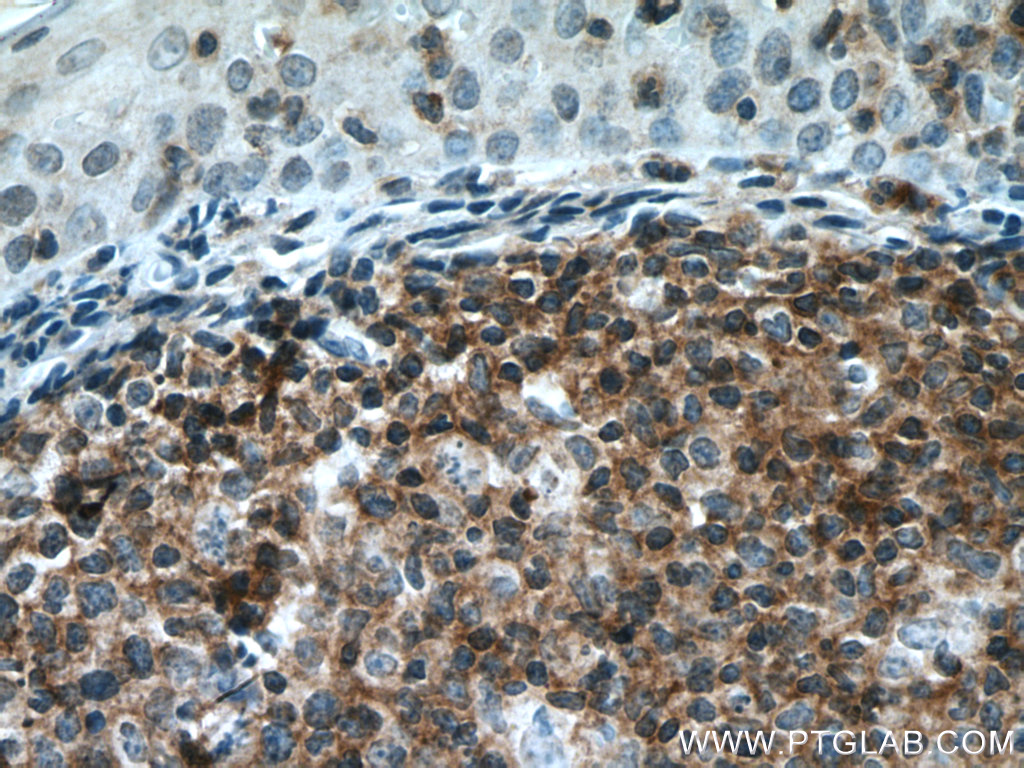 IHC staining of human tonsillitis using 21448-1-AP