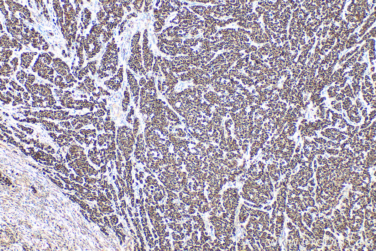 Immunohistochemical analysis of paraffin-embedded human colon cancer tissue slide using 13108-1-AP (PYCR1 antibody) at dilution of 1:400 (under 10x lens). Heat mediated antigen retrieval with Tris-EDTA buffer (pH 9.0). IHC staining of human colon cancer using 13108-1-AP