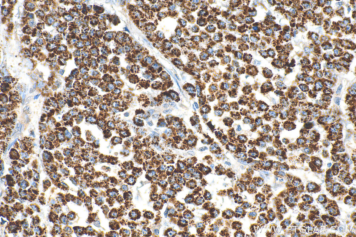 Immunohistochemical analysis of paraffin-embedded human colon cancer tissue slide using 13108-1-AP (PYCR1 antibody) at dilution of 1:400 (under 40x lens). Heat mediated antigen retrieval with Tris-EDTA buffer (pH 9.0). IHC staining of human colon cancer using 13108-1-AP