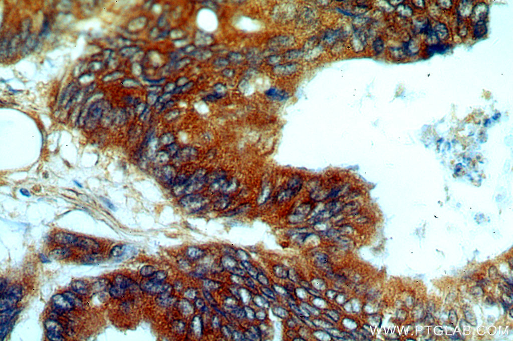 IHC staining of human colon cancer using 20962-1-AP