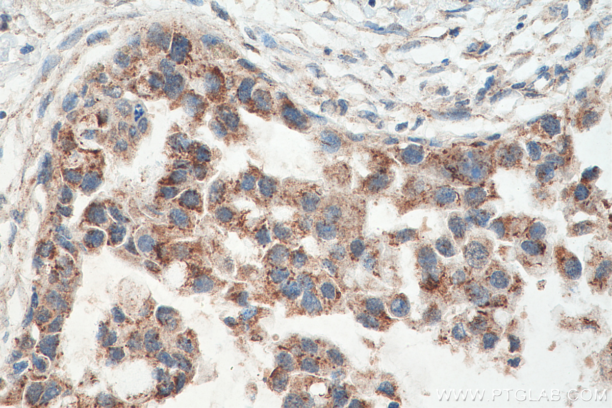 IHC staining of human breast cancer using 66510-1-Ig (same clone as 66510-1-PBS)