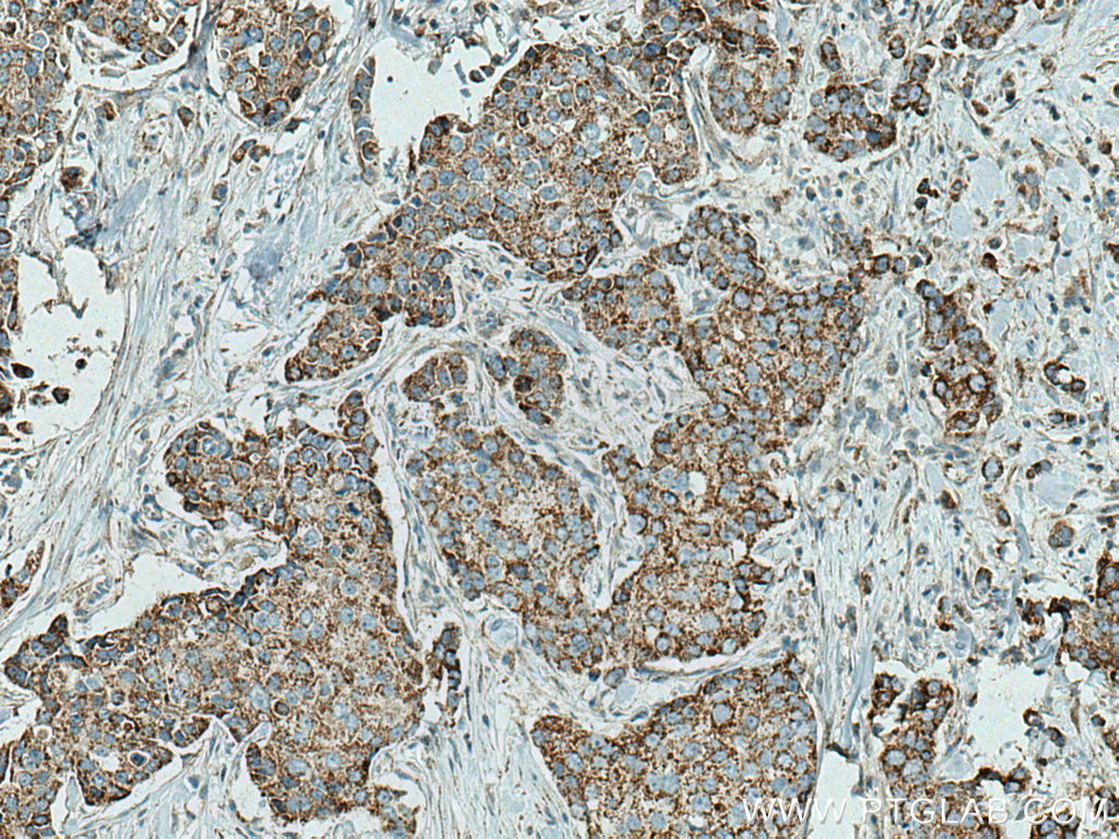 IHC staining of human breast cancer using 17146-1-AP