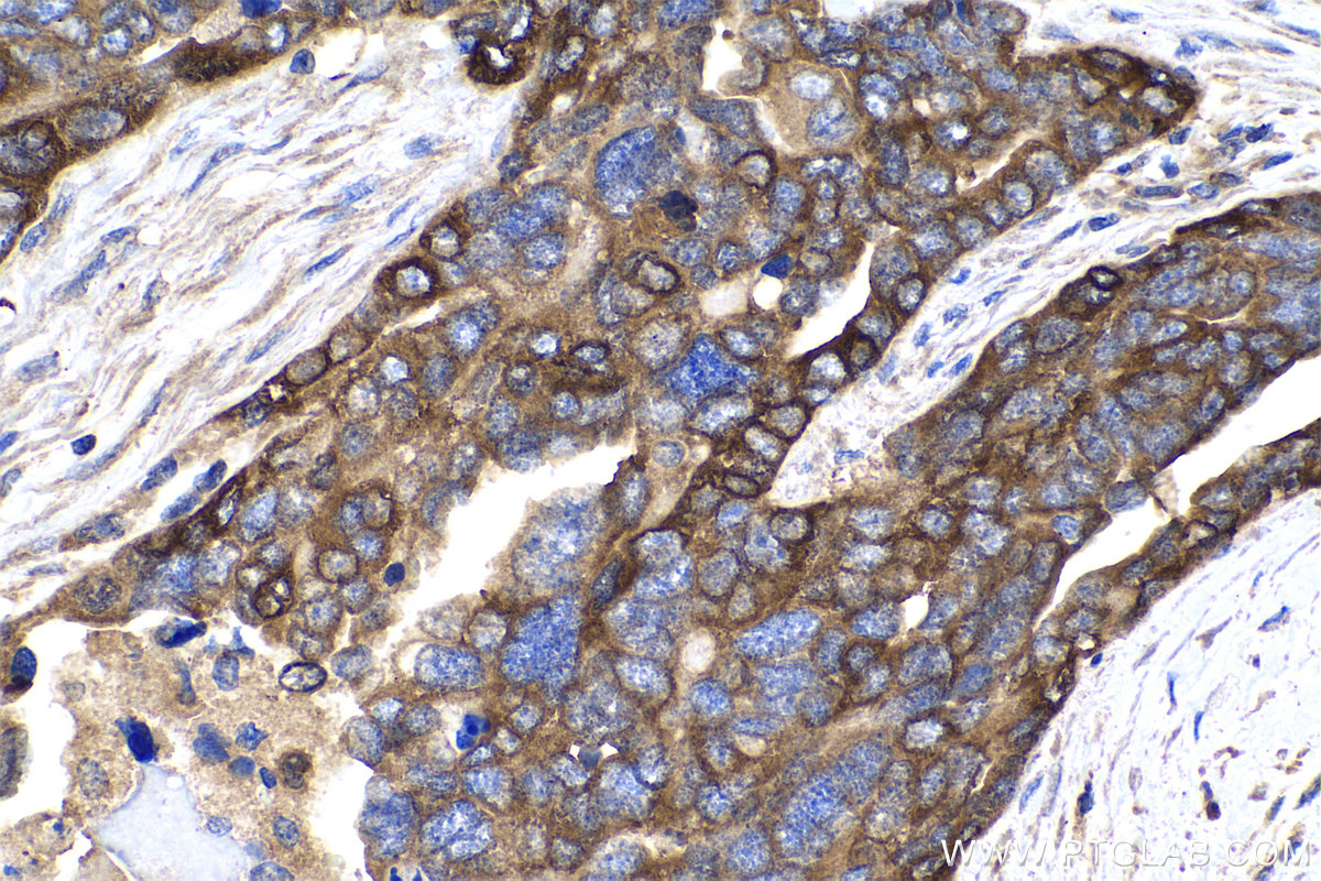 IHC staining of human ovary tumor using 12075-1-AP