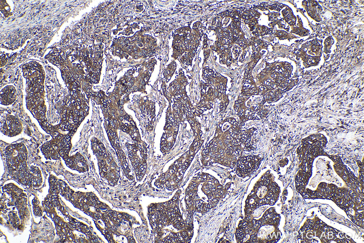 IHC staining of human stomach cancer using 12075-1-AP