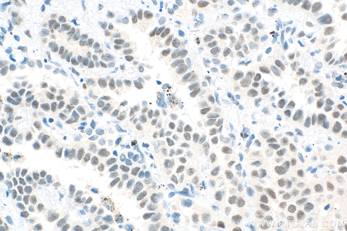 IHC staining of human lung cancer using 11555-1-AP