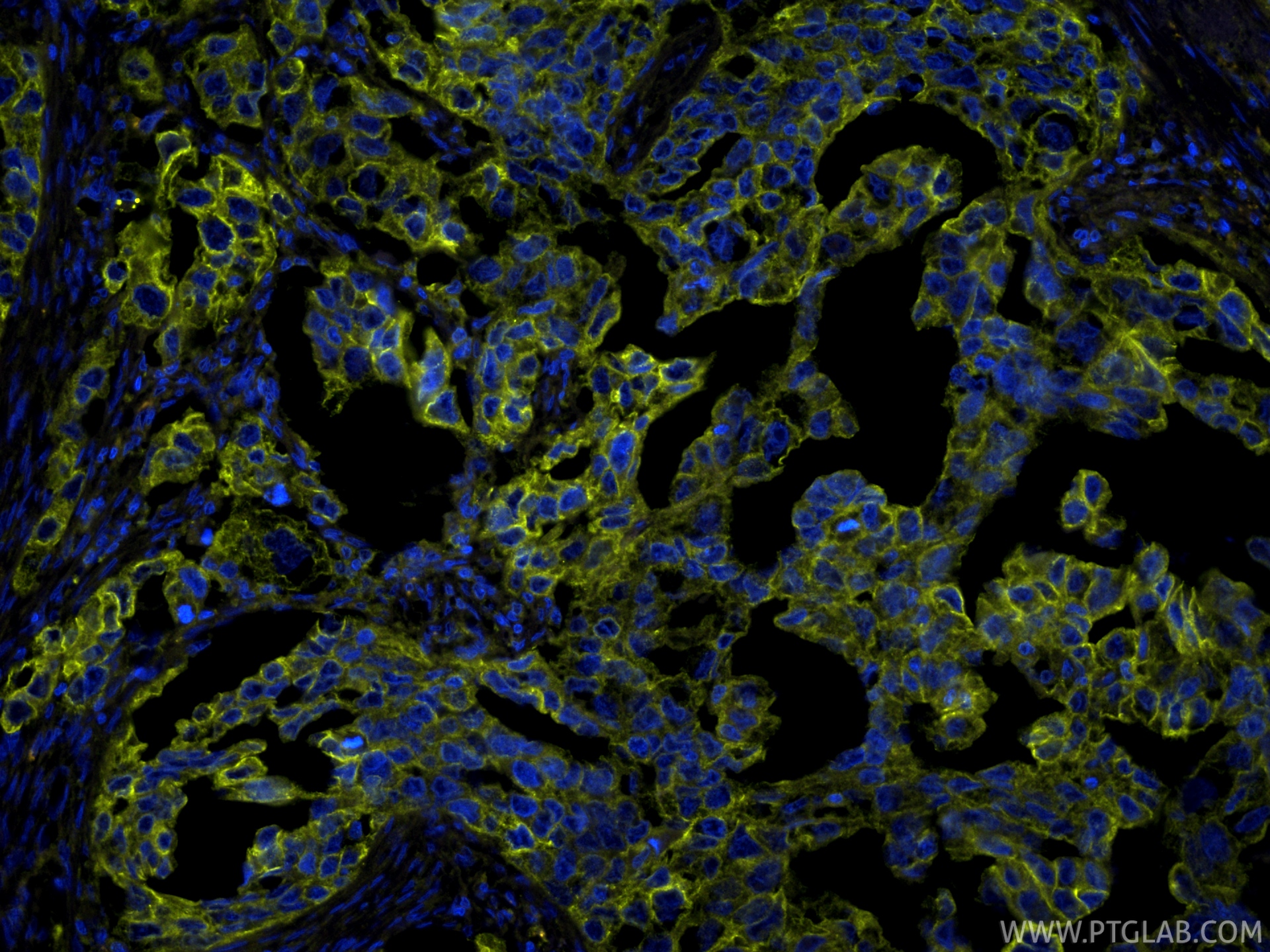IF Staining of human colon cancer using PE-86370 IF Staining of human colon cancer using PE-86370