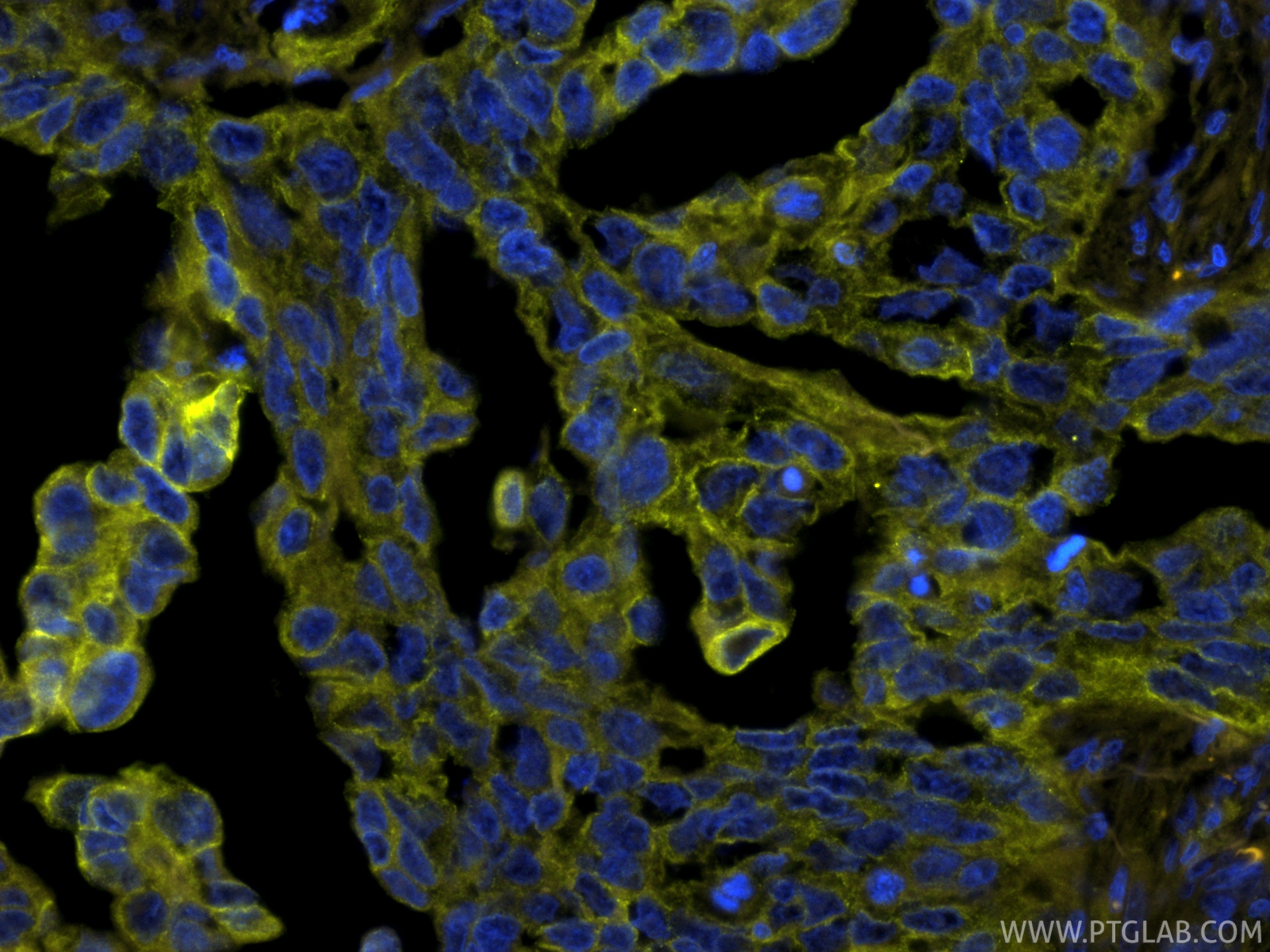 IF Staining of human colon cancer using PE-86370 IF Staining of human colon cancer using PE-86370