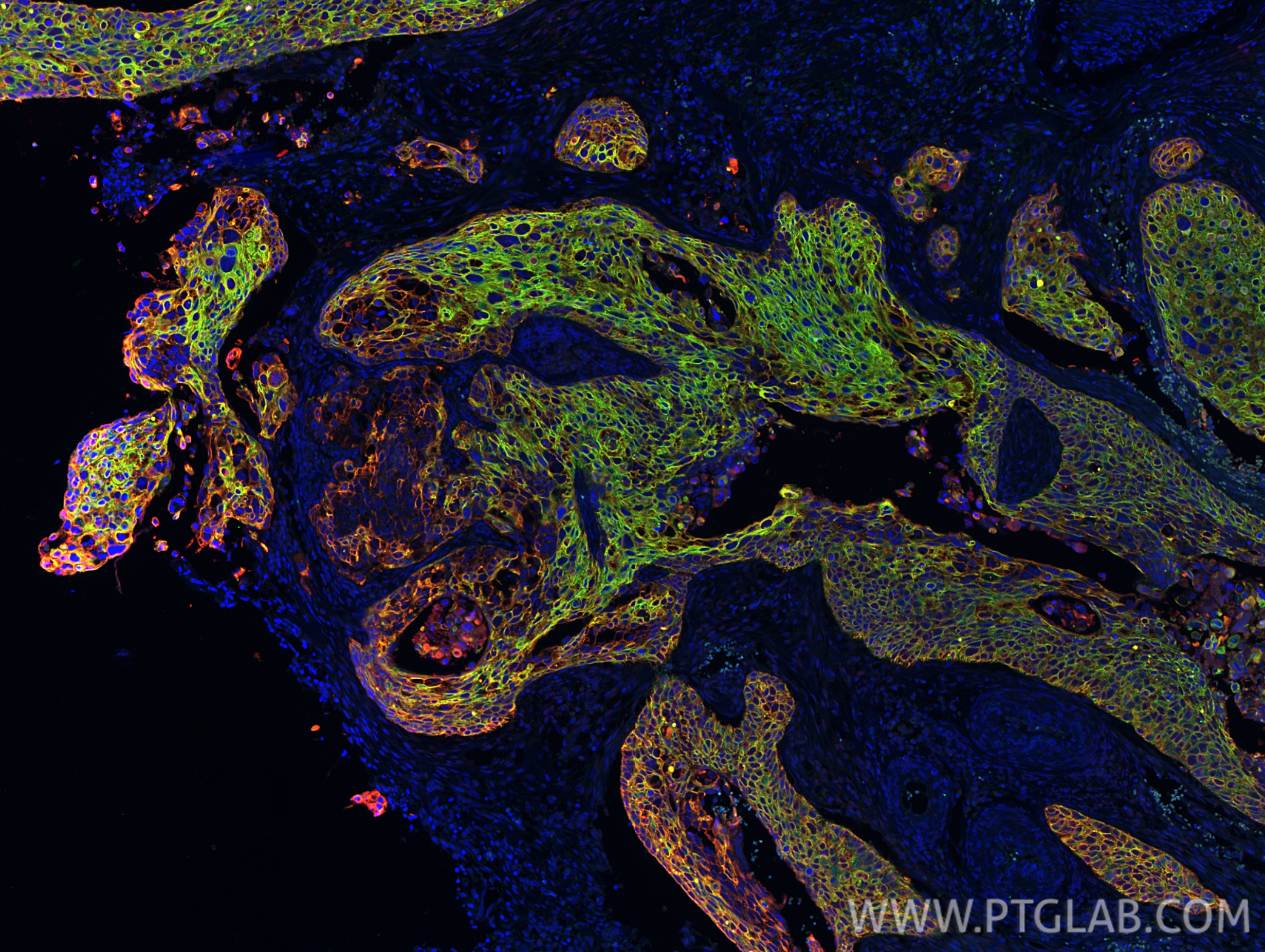 Immunofluorescent analysis of (4% PFA) fixed paraffin-embedded human cervical cancer tissue using Pan-Keratin (Type I) antibody (86238-2-RR, Clone: 251039C1 ) at dilution of 1:500 and CoraLite®594-Conjugated Goat Anti-Rabbit IgG(H+L) (<a class='green' href='/productredirect?CatalogNo=SA00013-4' target='_blank'>SA00013-4</a>), Pan-Keratin (TypeⅡ) antibody <a class='green' href='/productredirect?CatalogNo=86370-1-RR' target='_blank'>86370-1-RR</a> labeled with FlexAble 2.0 CoraLite® Plus 488 Kit (KFA501, green). Heat mediated antigen retrieval with Tris-EDTA buffer (pH 9.0). IF Staining of human cervical cancer using 86238-2-RR