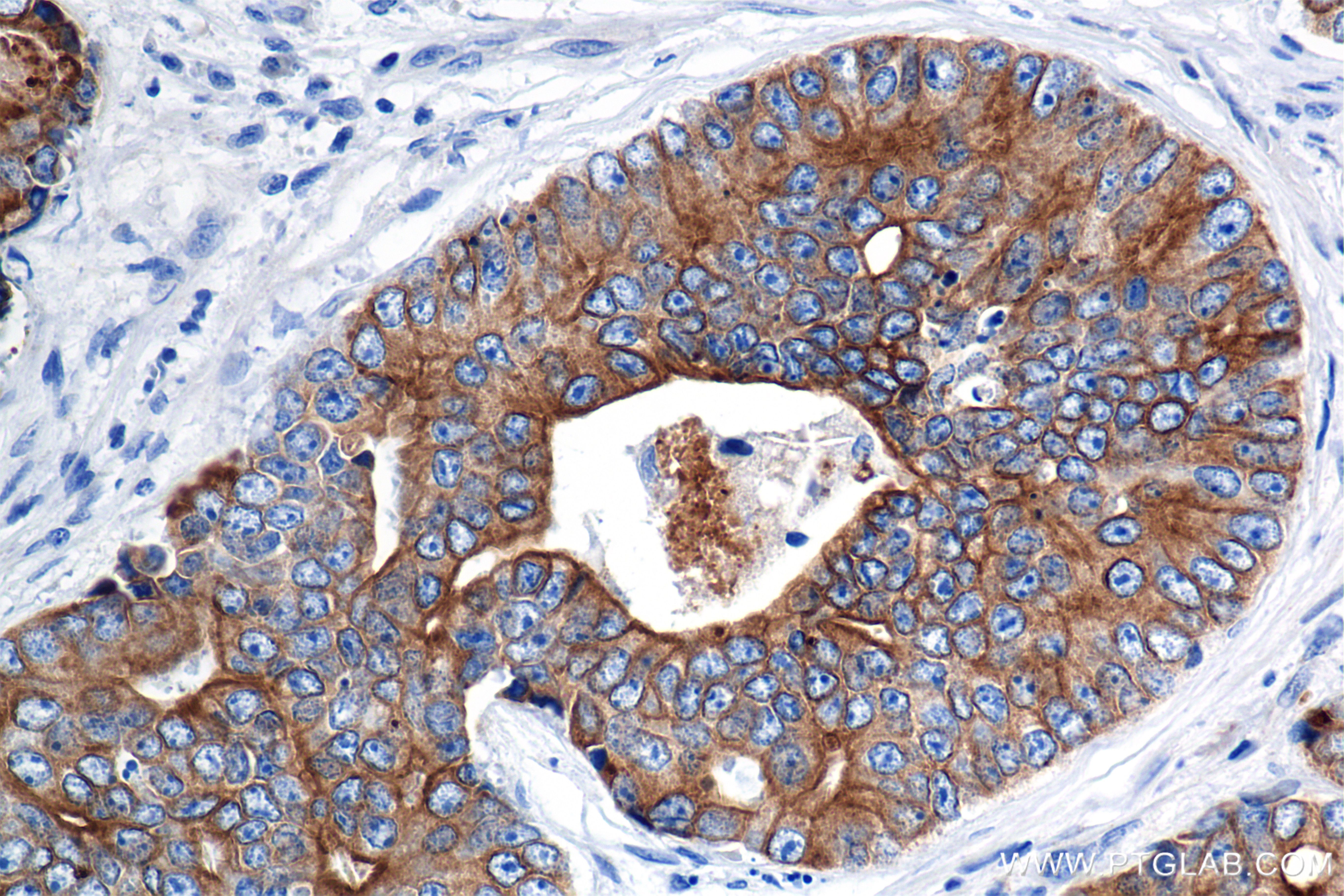 Immunohistochemical analysis of paraffin-embedded human prostate cancer tissue slide using 86238-2-RR (Pan-Keratin (Type I) antibody) at dilution of 1:1000 (under 40x lens). Heat mediated antigen retrieval with Tris-EDTA buffer (pH 9.0). IHC staining of human prostate cancer using 86238-2-RR