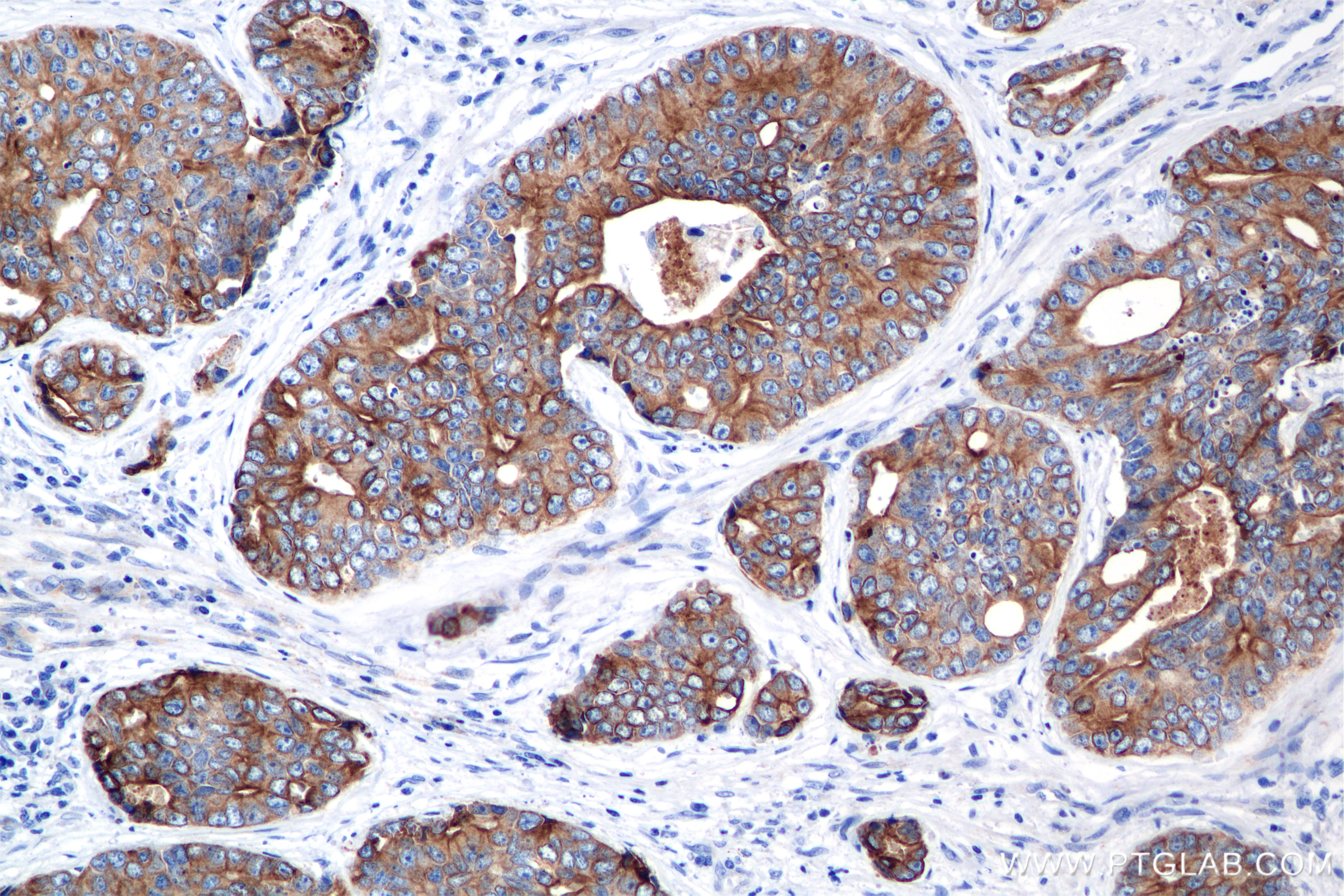 Immunohistochemical analysis of paraffin-embedded human prostate cancer tissue slide using 86238-2-RR (Pan-Keratin (Type I) antibody) at dilution of 1:1000 (under 20x lens). Heat mediated antigen retrieval with Tris-EDTA buffer (pH 9.0). IHC staining of human prostate cancer using 86238-2-RR