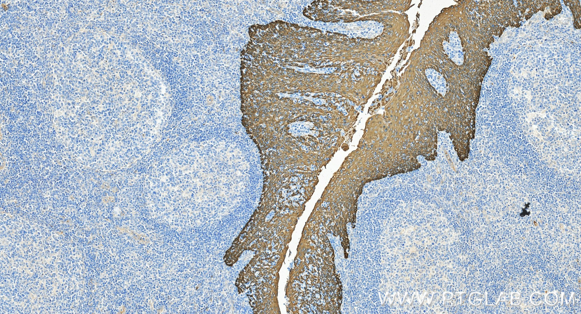 IHC staining of human tonsillitis using 86238-5-RR