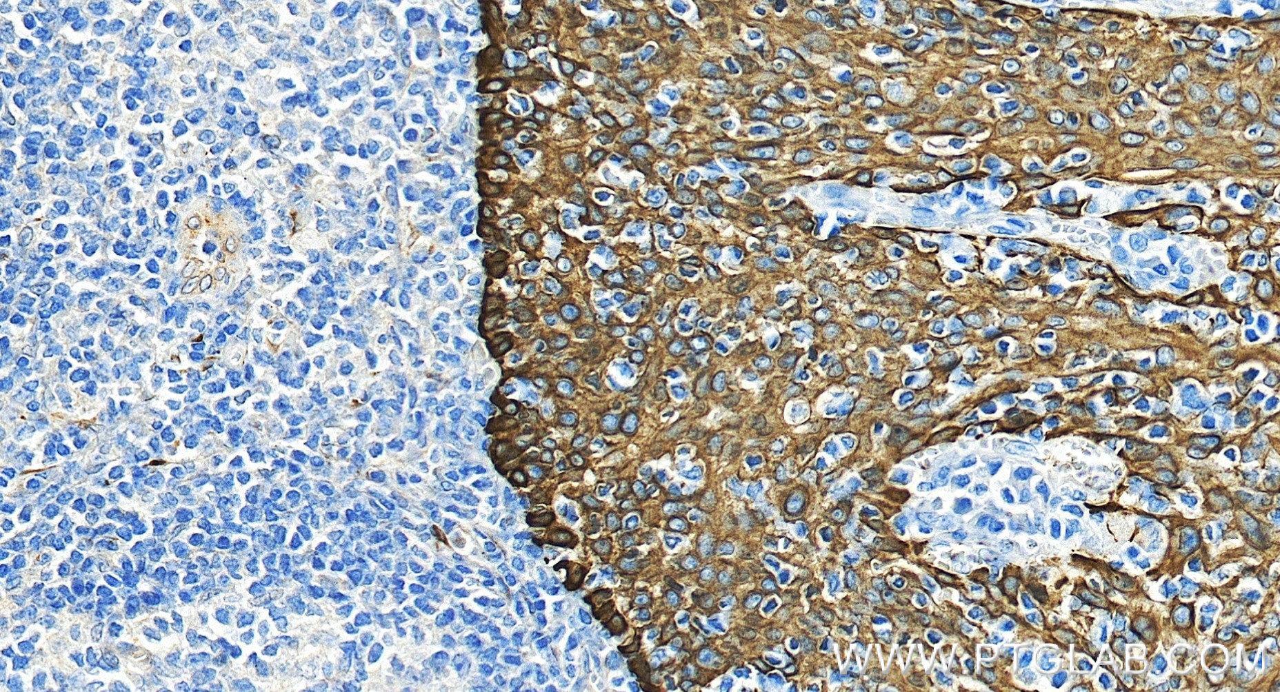 IHC staining of human tonsillitis using 86238-5-RR