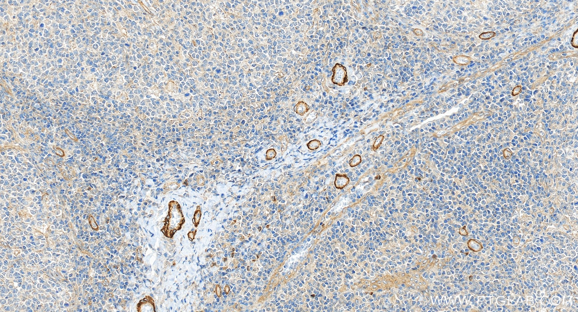 IHC staining of human tonsillitis using 84096-3-RR